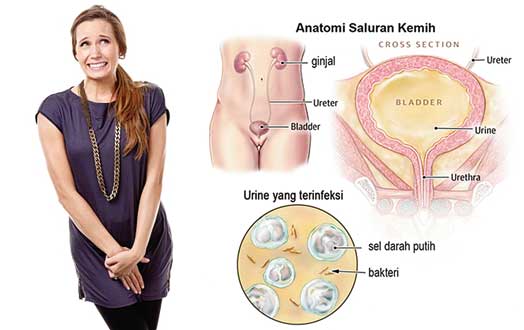 Ternyata Sakit Perut Sebelah Kiri Bawah Infeksi Saluran Kemih